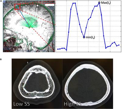 The Distribution of Skull Score and Skull Density Ratio in Tremor Patients for MR-Guided Focused Ultrasound Thalamotomy